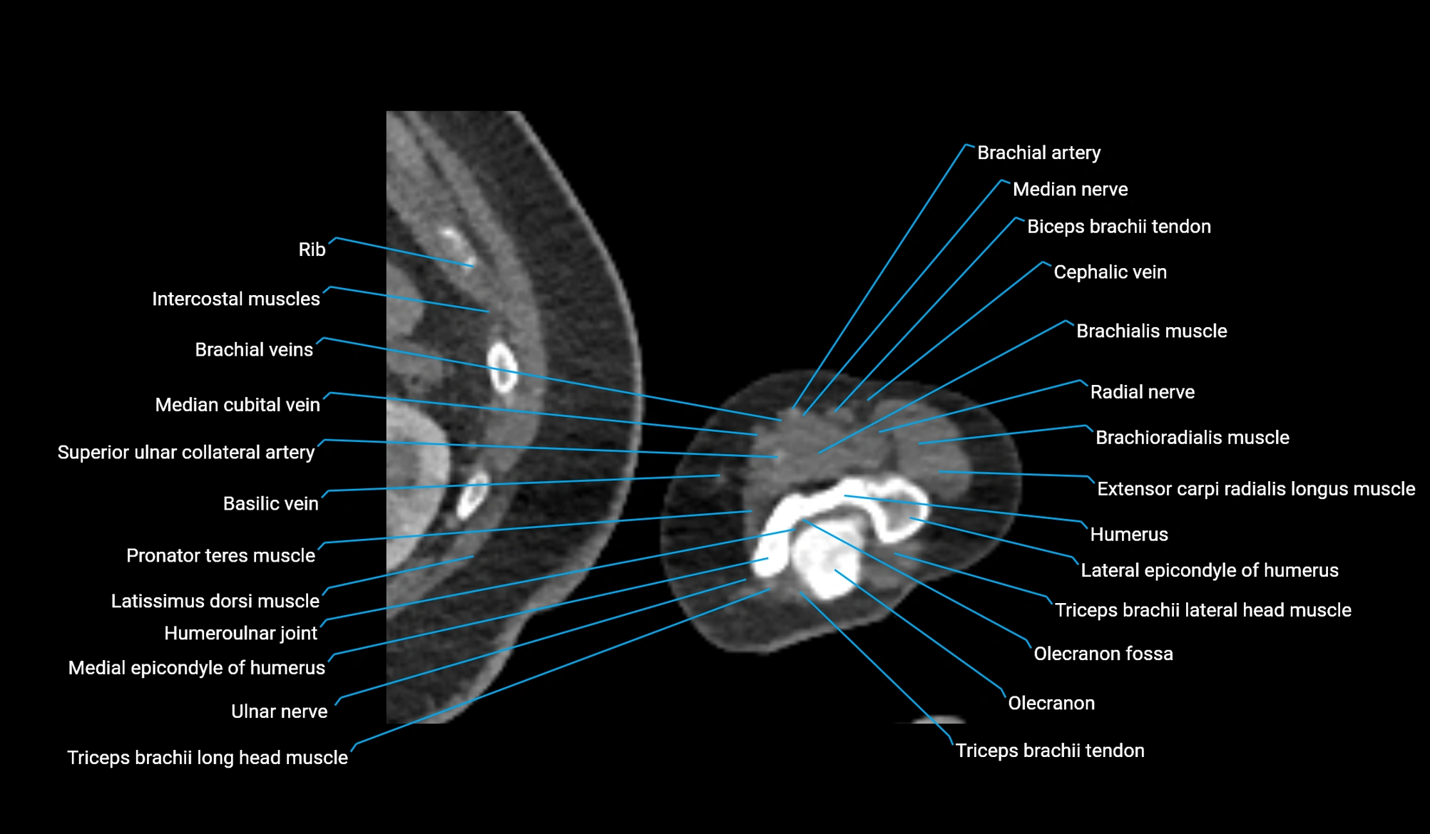 CT upper arm axial  cross sectional anatomy labelled radiology image -00374.webp